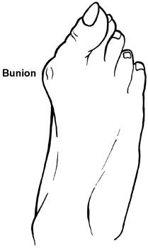 Schéma du pied montrant un oignon