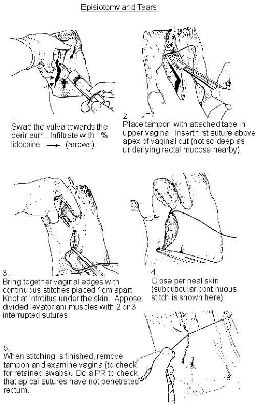 ÉPISIOTOMIE ET DÉCHIRURES