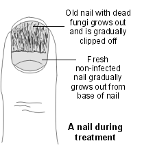 Schéma d'un ongle pendant le traitement d'une infection fongique de l'ongle