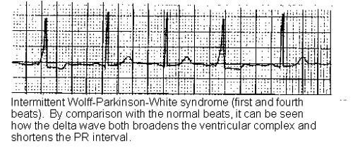 LE SYNDROME DE WOLFF-PARKINSON-WHITE