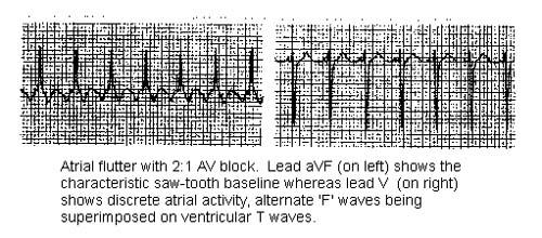 FLUTTER ATRIAL