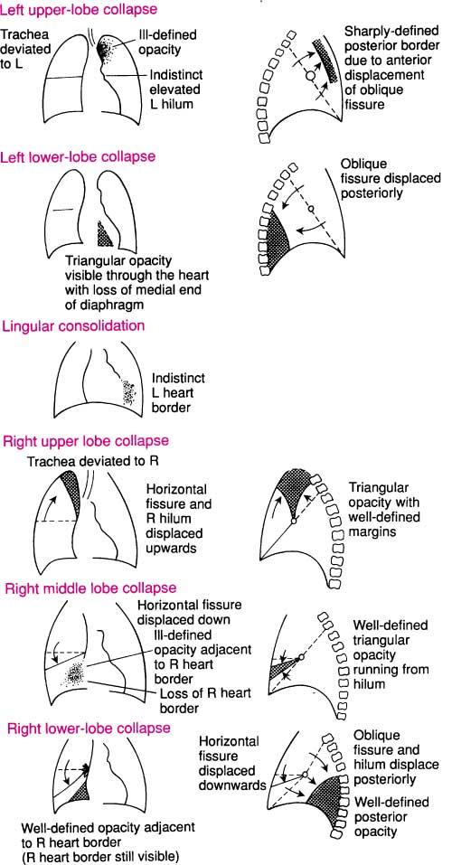 RADIOGRAPHIE DU THORAX - INTERPRÉTATION