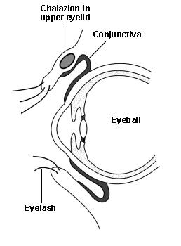 chalazion de la paupière supérieure