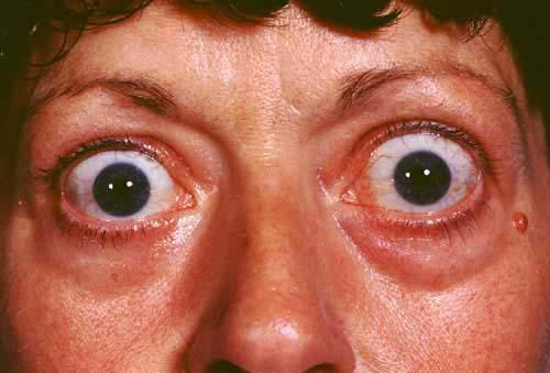 Thyrotoxicose