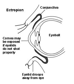 Schéma en coupe d'un œil montrant un ectropion