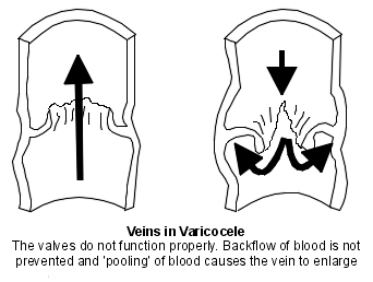 Valves veineuses anormales