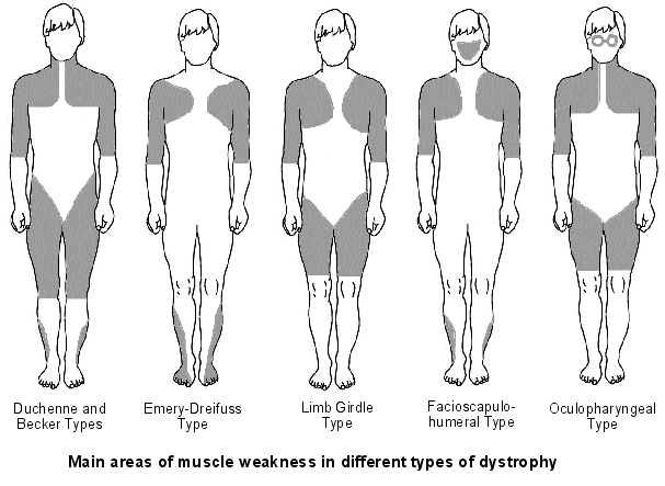 faiblesse musculaire dans les types de dystrophie