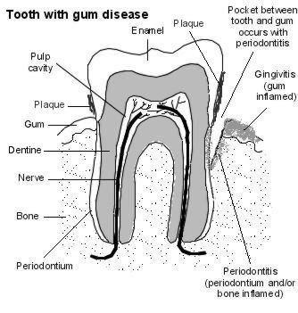 dent avec maladie des gencives