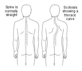 scoliose