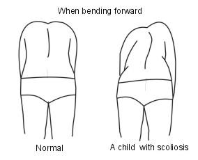 diagnostic de la scoliose