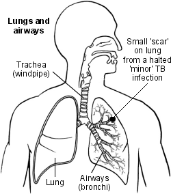 Poumons et voies respiratoires avec cicatrice de tuberculose