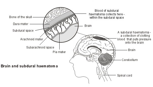 hématome sous-dural