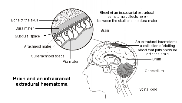 hématome extradural