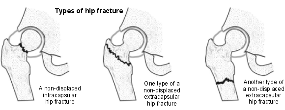 fracture de la hanche
