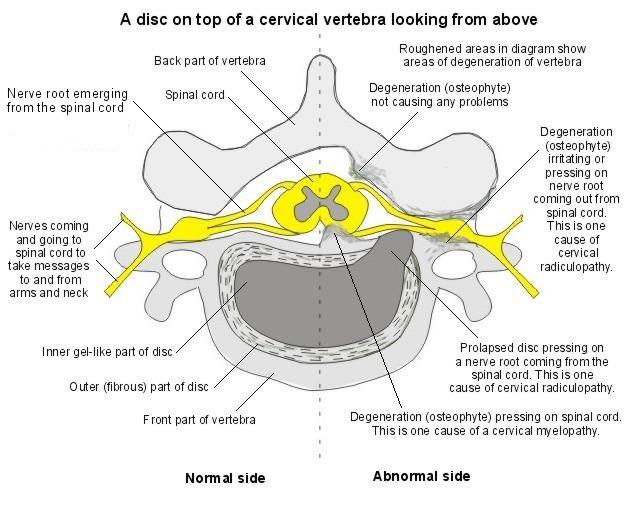 Vertèbre cervicale (Beverley Kenny)