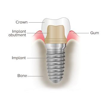Implantation d'un cure-dent