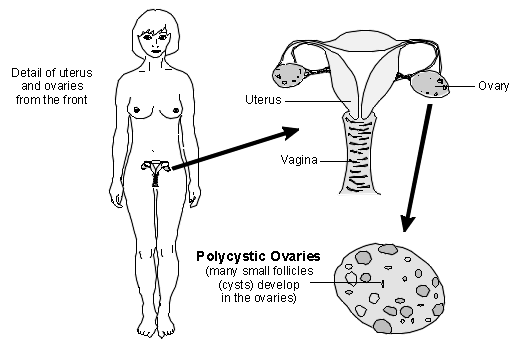 ovaires polykystiques