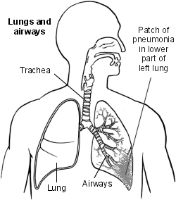 Poumons présentant des signes de pneumonie