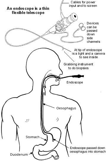 Gastroscopie