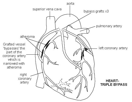 Triple pontage cardiaque