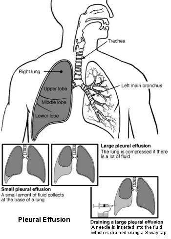 Poumons et voies respiratoires avec épanchement pleural