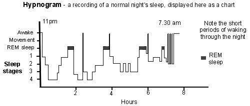 Hypnogramme - graphique d'une nuit de sommeil normale