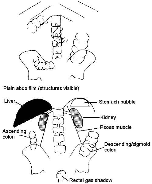 RADIOGRAPHIE ABDOMINALE