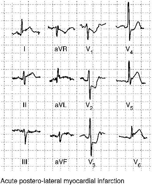 INFARCTUS DU MYOCARDE