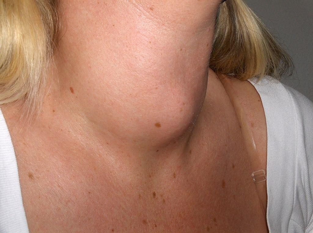 thyroid lumps