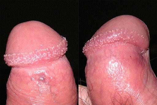 Photo des papules nacrées du pénis