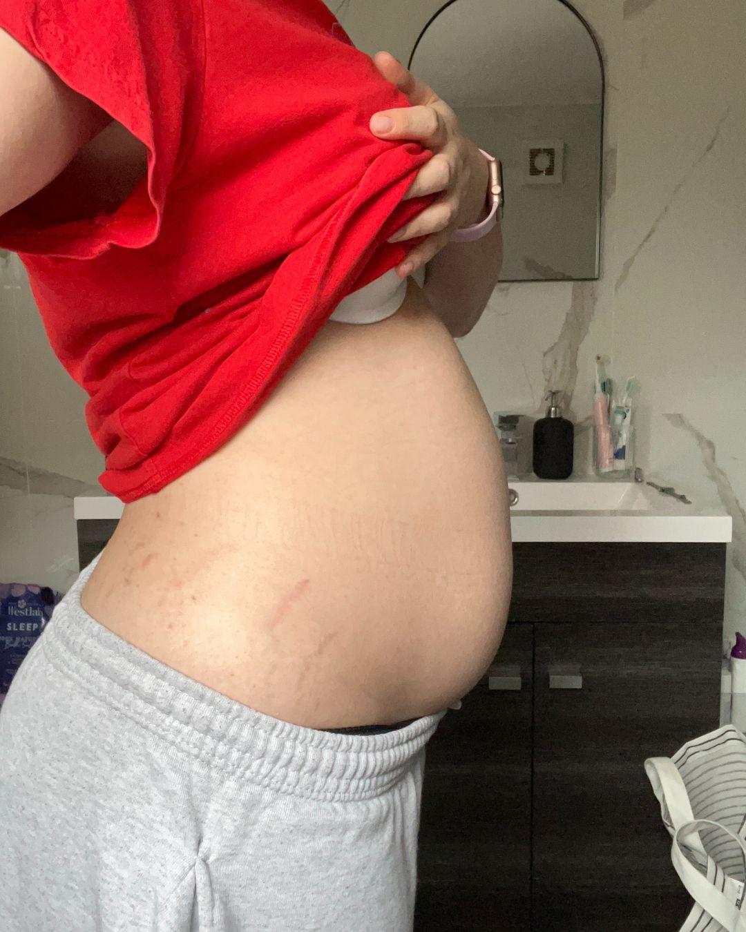 Photographie d'une jeune femme levant son tee-shirt pour montrer un ventre anormalement gonflé.