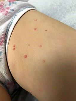 Molluscum contagiosum