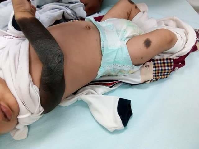 Navette mélanocytaire congénitale