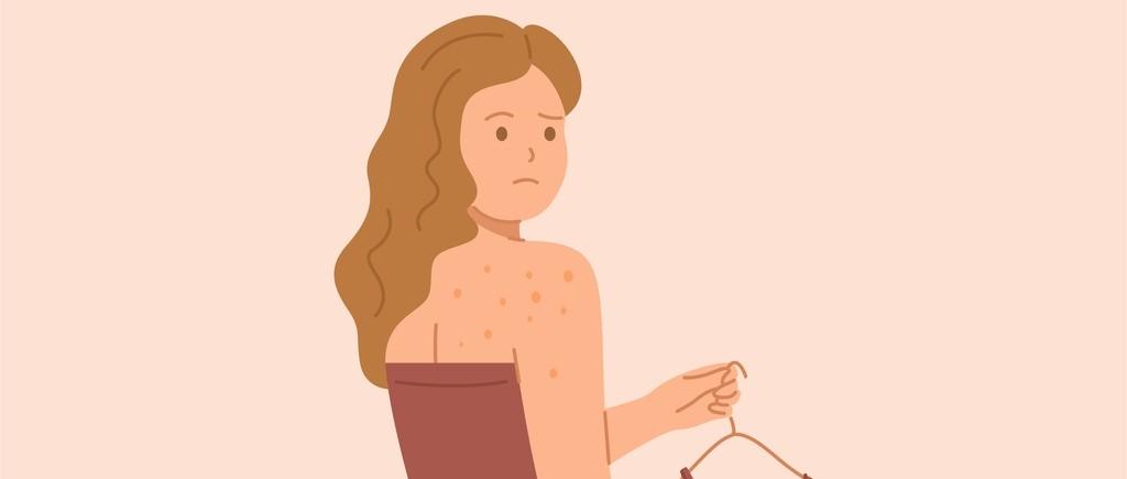 8 causes de l'acné du dos