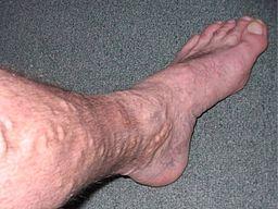 Varices sur la jambe