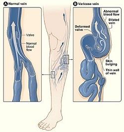 Varices