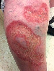 Nécrobiose lipoïdique