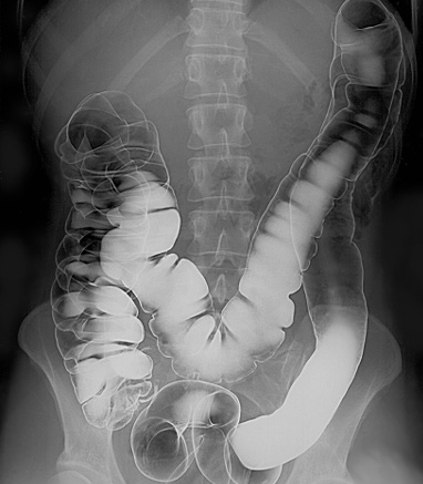 Imagerie du tractus intestinal humain par lavement baryté à double contraste