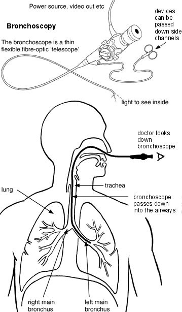 Diagramme montrant comment se déroule une bronchoscopie