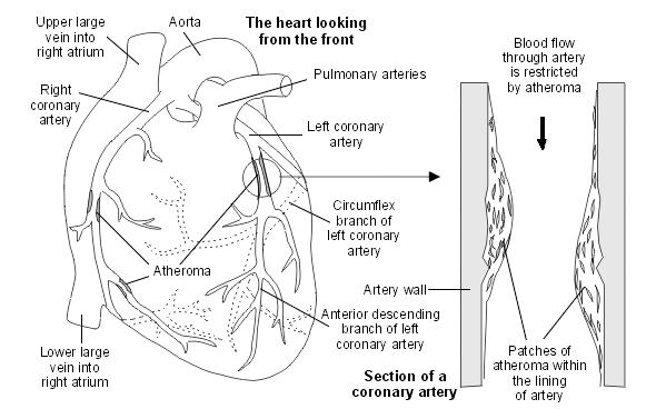 Heart with atheroma