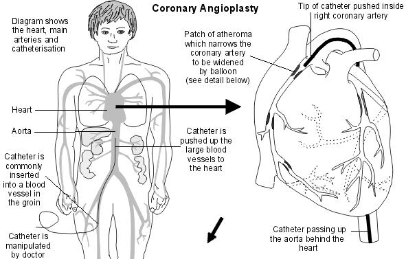 Angioplastie coronaire