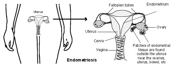Endométriose