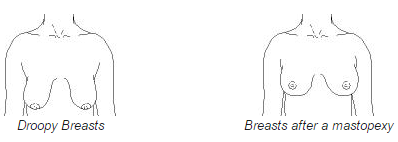 Seins tombants avant et après la mastopexie