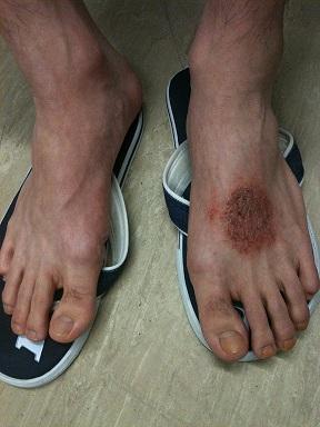 Lichen simplex sur le dos du pied d'un jeune homme