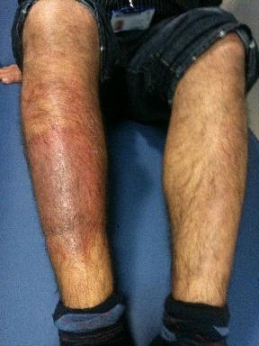 Lichen simplex sur le tibia d'un jeune homme