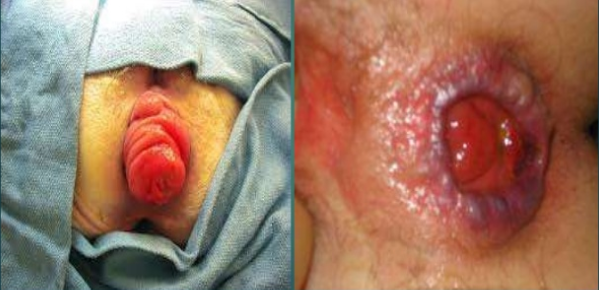 Prolapsus rectal