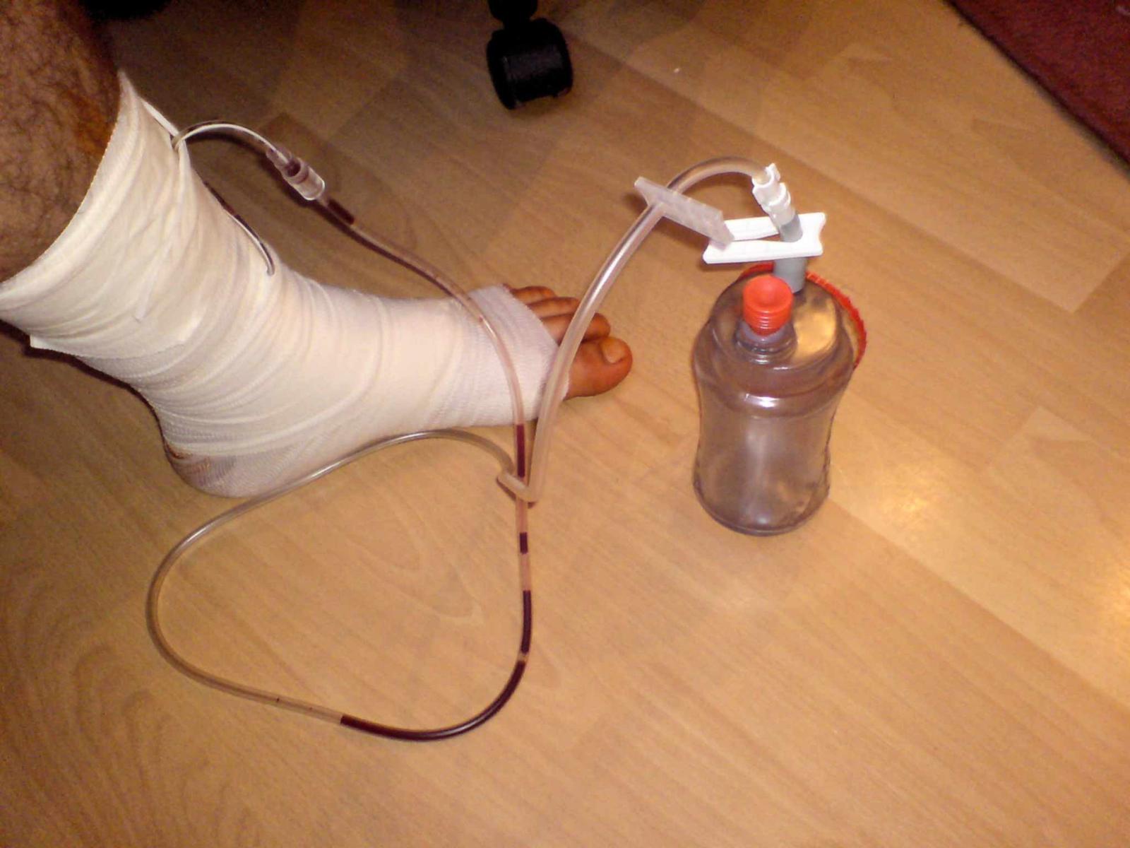 image en libre accès du drain chirurgical de la jambe