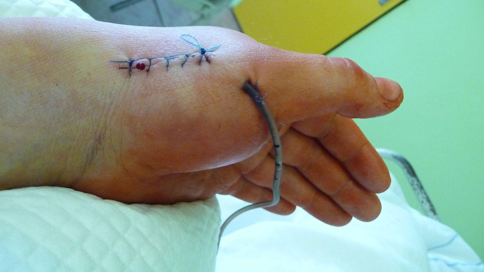 drain chirurgical pour la main à accès ouvert