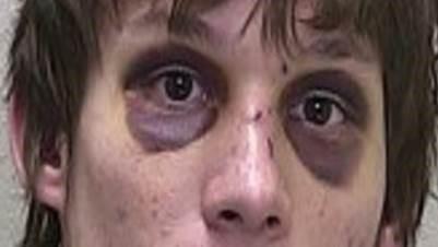 Ecchymose périorbitaire bilatérale