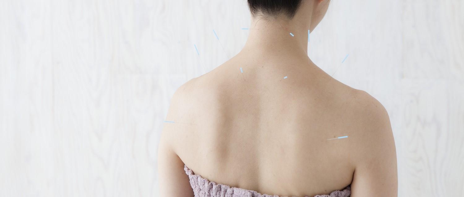 Acupuncture